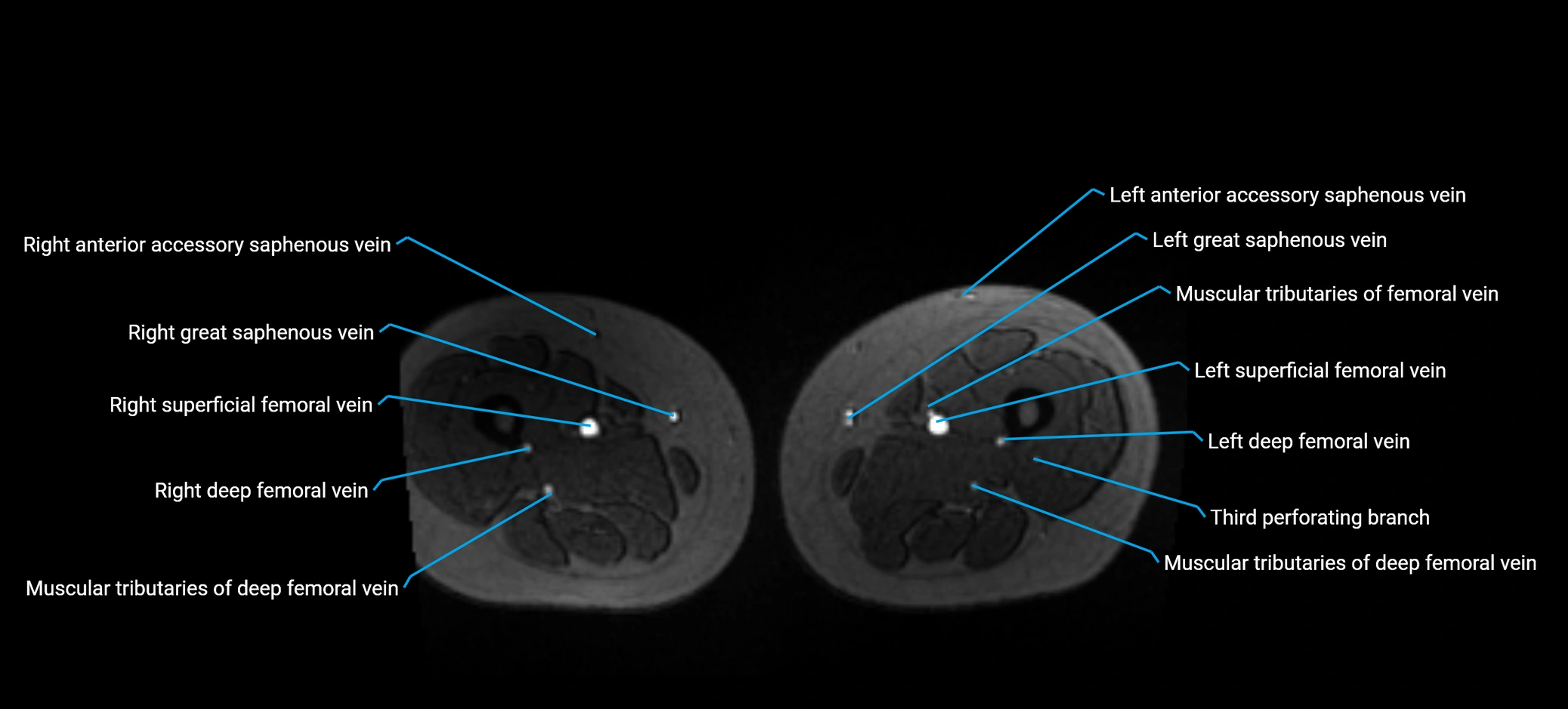 MRV abdomen pelvis & lower limb axial cross sectional anatomy labelled MRI image 273 (1).webp